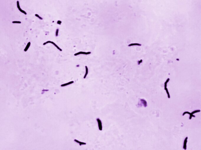 世界衛生組織稱，去年結核病導致 123 萬人死亡
| mtgamer.com